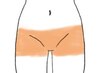 【４０代５０代から始める】広範囲対応！VIO脱毛ボクサーライン