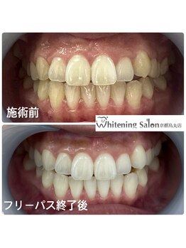 ホワイトニングサロン 京都烏丸店/ホワイトニング施術例