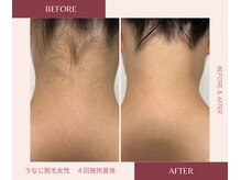 ウェルネス ステーション リンク(Wellness Station Link)/うなじ脱毛