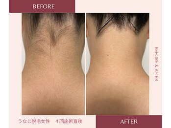 ウェルネス ステーション リンク(Wellness Station Link)/うなじ脱毛