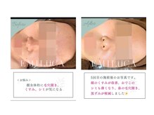 エミルカ 岡山店(EMILUCA)/お尻の施術事例5回目施術後