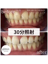グリッター ショウナン(glitter. SHONAN)/ホワイトニングで自信がもてる！