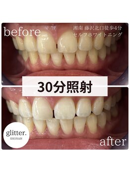 グリッター ショウナン(glitter. SHONAN)/ホワイトニングで自信がもてる！