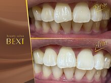 ベクスト(BEXT)/セルフホワイトニング