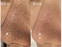 ラシック(LACHIC)/毛穴洗浄×プラズマフェイシャル