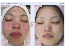 リノア 堀江(Linoa)/5ヶ月後 before→after