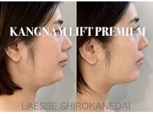 ラエッセ 目黒 白金台店(LAESSE)/立体小顔×幹細胞導入