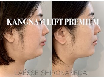 ラエッセ 目黒 白金台店(LAESSE)/立体小顔×幹細胞導入