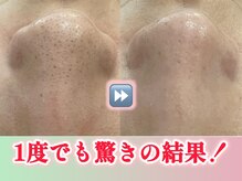 グラート(Grato)の雰囲気(一度でこの結果!毛穴洗浄で驚きの毛穴&美白!ピーリングも人気)