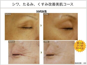 ベッラドンナ(Bella donna)/目元のシワケア BeforeAfter