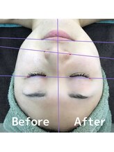 シェール(Cher)/人気の光フェイシャル