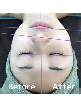 シェール(Cher)/人気の光フェイシャル