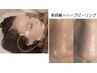 【人気No.1】小鼻の黒ずみに和漢ハーブピーリング＋美容鍼 ￥20,800→￥8800