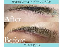 リメイククリニカルビューティー(Remake clinical beauty)/くっきり残る跡も