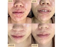 ホワイトアクア 明石店(WHITE AQUA)/ハーブピーリング/ニキビケア