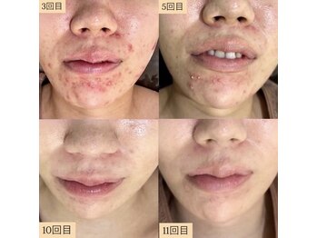 ホワイトアクア 明石店(WHITE AQUA)/ハーブピーリング/ニキビケア