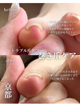 アイル(isle)/【巻き爪でお悩み】のお客様