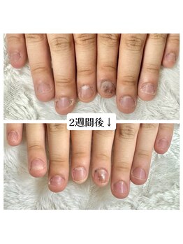 グラシナ 鳥丸店/同じ方の自爪です