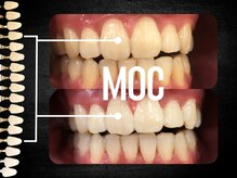 モック 麻布十番(MOC)/ホワイトニング/麻布十番/六本木