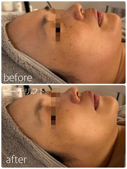 シャンス(Chance)/ピーチリフト 1回目症例