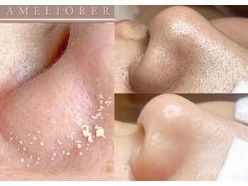 アメリオレ 国分寺店(AMELIORER)の写真/【気になるイチゴ鼻・黒ずみ・角栓】奥深くからアプローチ「毛穴エクストラクション60分￥11500」