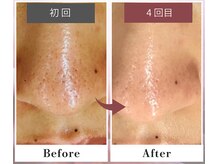 フルリール/【毛穴デトックス】