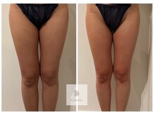 マシェリ 吉祥寺(Macherie)/脂肪燃焼　10ml導入