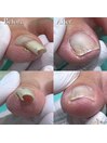 【巻き爪/陥入爪】