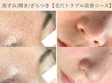 エミルカ 仙台(EMILUCA)の雰囲気(長年苦しんだ毛穴悩みから解放!全顔ケアでつるんと毛穴美人に!)