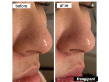 フランジパニ(Frangipani)/【30代】毛穴汚れ、ザラつき悩み