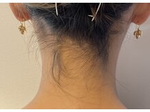 フォクシーワックス 立川店(FOXY WAX)/【ビフォー】うなじ