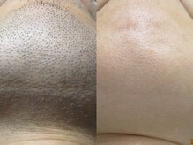 美容脱毛専門サロン エピラージュ 新宿店(Epilage)/青髭も荒井式脱毛でツルツルへ！