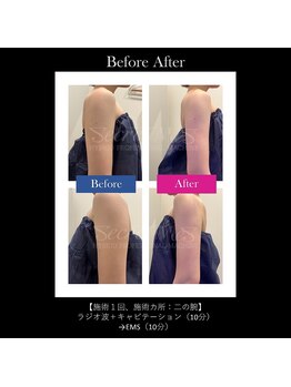 ベルフィーヌボーテ(BELFINE beaute)/シークレットM二の腕