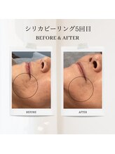 エクラ アン(eclat.un)/60代女性：シリカピーリング