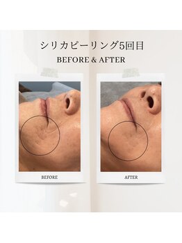 エクラ アン(eclat.un)/60代女性：シリカピーリング