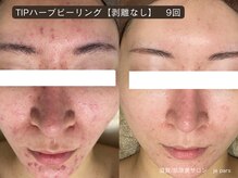 ジュパール(je pars)/TIPハーブピーリング剥離なし　