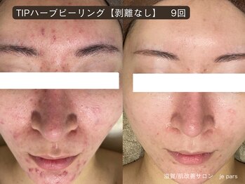 ジュパール(je pars)/TIPハーブピーリング剥離なし　