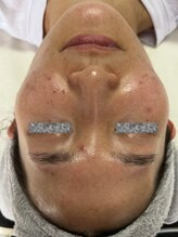 リアスキン(Lia skin)/ニキビでお悩みの方