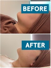 ヴォアール 東静岡店(VOIR)/お顔の脂肪分解剤導入