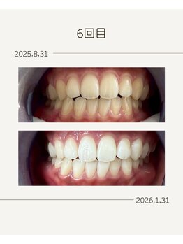 ホワイトニングショップ 福岡姪浜店/お客様before after