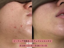 フォーティチュード(FORTITUDE)