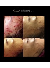 アンヘル(Angel)/ニキビケアにはリアボーテ