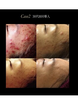 アンヘル(Angel)/ニキビケアにはリアボーテ