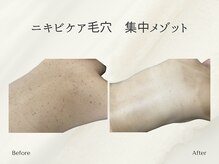 ホリスティックサロン ヘルバ(Holistic salon Herba)/跡ニキビケア毛穴　施術変化