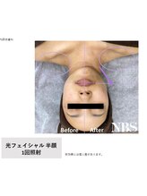 アトリア(ATRIA)/光フェイシャル＋専用フィルター