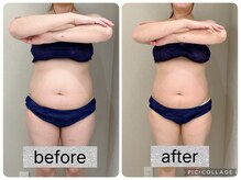 イヨヨ(iyoyo)/【痩身】Before After