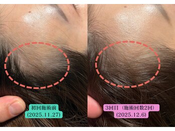 やなけん 亀戸店/20代後半女性 生え際のお悩み