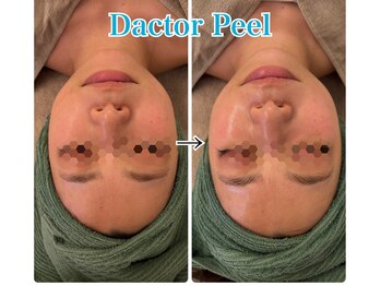 ネオズエゴ アーチ(neos ego Archi)/ダクトピール　ビフォーアフター