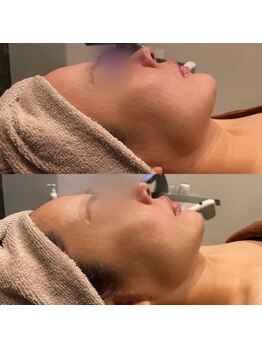 ビュウナ 銀座(BEAUNA)/マルチウェーブリフト