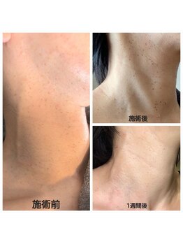 ディープブルー(Deep Blue)/プラペンデュアル施術